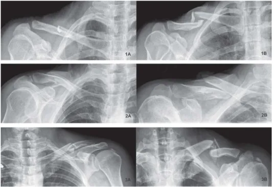 Figure 2 Three  series  of  anteroposterior  (A)  and  30-degree  caudocephalad  (B)  radiographs  of midshaft clavicular fractures.