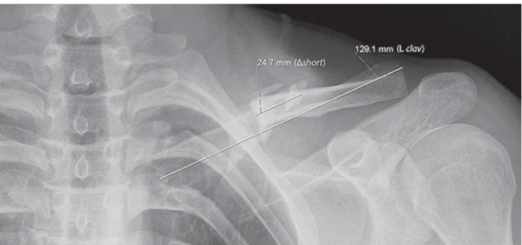 Figure 1 Measurement  of  clavicular  length  and  shortening  after  a  midshaft  fracture,  on  the anteroposterior trauma radiograph (A) and anteroposterior panorama radiograph (B).
