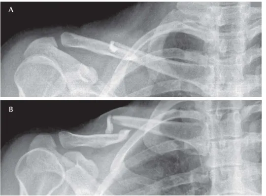 Figure 1.  AP view (A) and 30-degree caudocephalad view (B) radiographs of one of the 15 midshaft clavicular fractures presented in the survey.