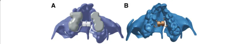 Fig. 1 Three-dimensional model of a conventional HYRAX expander and b bone-borne palatal expander