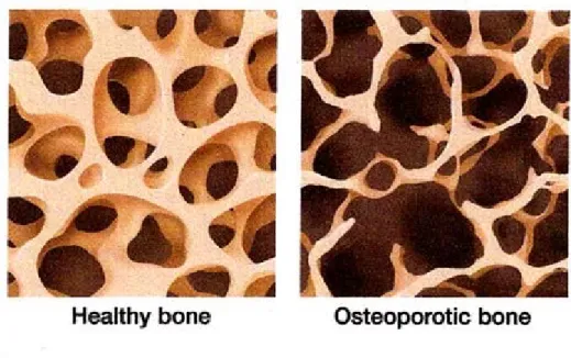 Figure 6: Healthy and osteoporotic trabecular bones 