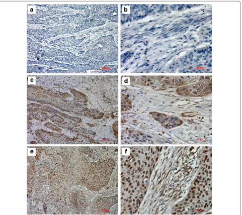 Fig. 5 Immunohistochemical staining for HSF1 in stromal cells of ESCC. The negative expression level (a ×100; b ×400), low expression level (c ×100; d ×400) and high expression level (e ×100; f ×400) of HSF1 in tumor stroma from patients with ESCC