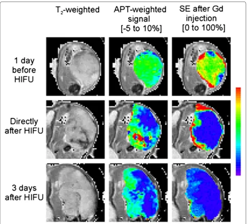 Fig. 7 Monitoring HIFU treatment in cancer. Proton anatomical image, APT weighted image and GD contrast enhanced image show the changes in tumor following HIFU treatment