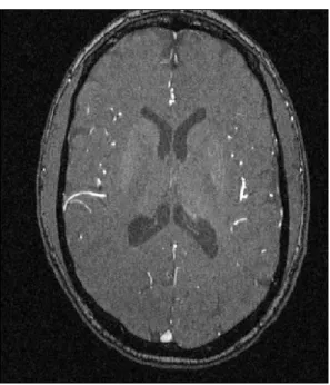 Figure 1.1: Example MRA Image