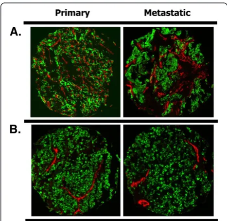 Figure 1 High (panel A) and low (panel B) microvessel areaboth primary and metastatic specimens is shown in panelcorresponding MVA scores were 14.92% and 18.93%, respectively forpanelrepresented in panel(MVA) in matched primary and metastatic specimens by 