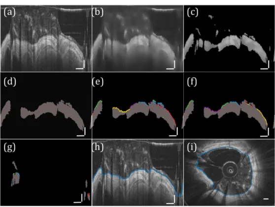 Fig. 3. Segmentation of airway lumen. (a) Input image. (b) Input image after Wiener Filter is  applied