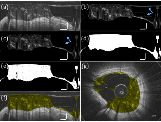 Fig. 4. Segmentation of airway mucus. (a) The input image. (b) The image after filtering and  thresholding are performed