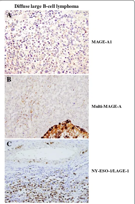 Figure 1 Immunohistochemical detection of MAGE-A1,multi-MAGE-A, and NY-ESO-1/LAGE-1 in diffuse large B-celllymphoma tissues