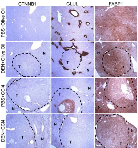Figure 2.1.  Immunostaining of CTNNB1, GLUL, and FABP1 in formalin-fixed paraffin-embedded  sections of liver tumor (T) and adjacent non-tumor (N) liver tissue
