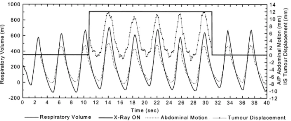 Figure 2.3: An example of a spirometer, abdominal displacement sensor, and fluoroscopy mea- mea-surement (Patient 7)
