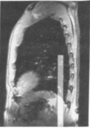 Figure 2.4: Visualization of the positioning of an MR Navigator Echo. The arrow points to the edge of the diaphragm that is tracked and used for gating, or as a respiratory surrogate