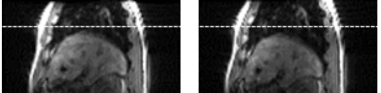 Figure 3.5: Image section showing location of the apex of the liver at (left) end-expiration and (right) end-inspiration.
