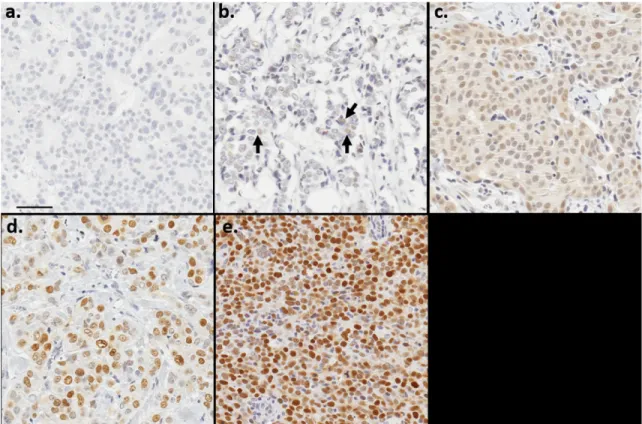Figure 1. Examples of manually scored p53 staining intensity categories a. No staining (0) b