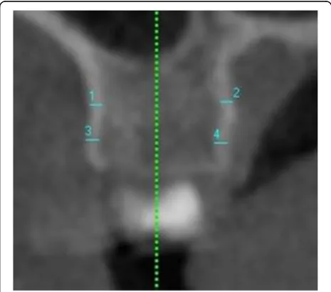 Fig. 2 Orientation of views for the inter-radicular measurements.a Orientation of sagittal slice