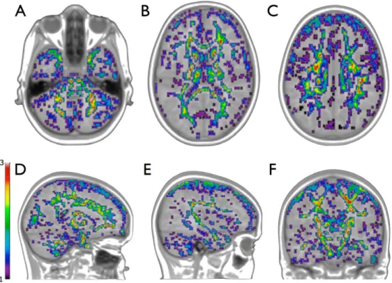 Figure 1. Significant tissue expansion: Significant Jacobian values . 1 overlaid on the model brain
