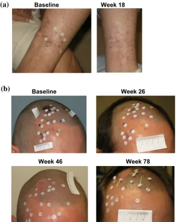 FIG. 4 Examples of patients treated with T-VEC with a DR without PPR. a Patient without PPR and DR onset B6 months