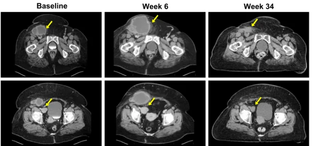 FIG. 5 Example of a patient treated with T-VEC with a durable response and PPR due to enlargement of existing lesions