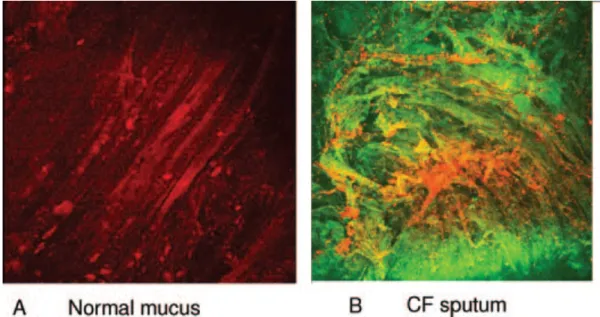 Figure 1.14 Laser scanning confocal micrograph of normal mucus (A) and sputum of a CF  patient (B)
