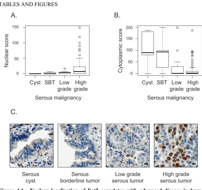 Figure  4.1.    Nuclear  localization  of  Ect2  correlates  with  advanced  disease  in  human  serous  epithelial  ovarian  cancers