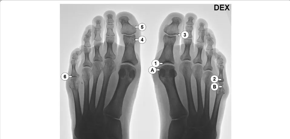 Figure 1 The patient radiograph taken before the first surgery. The locations of the samples taken are presented by A and B for the firstoperation and numbered from 1–6 for the second operation.