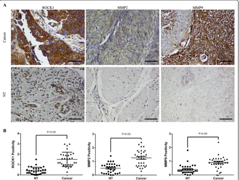 Figure 5 IHC analysis of ROCK1, MMP2 and MMP9 expression pattern in bladder cancer tissues