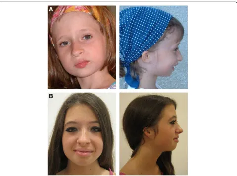 Fig. 1 Facial features of Meier-Gorlin syndrome. Patient A is a girl aged 7 years and 9 months with two mutations in ORC4