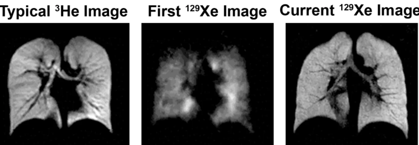 Figure 1.1: Left: Image of healthy lungs using 350 ml of HP 3 He at a polarization of ∼35%