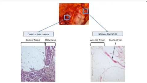 Figure 7 Pathological aspects of normal omentum and omental metastasis.