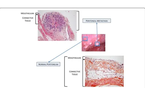 Figure 5 Macroscopic aspects of peritoneal carcinomatosis. (A) Isolated lesions. (B) Confluent lesions