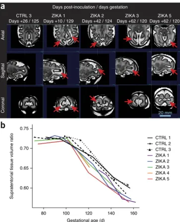 Figure 1  Fetal brain MRI imaging and volume analysis. (a) Serial fetal  brain MRI images (HASTE) from fetuses of pigtail macaques inoculated  with ZIKV or control medium showing differences in structure and volume