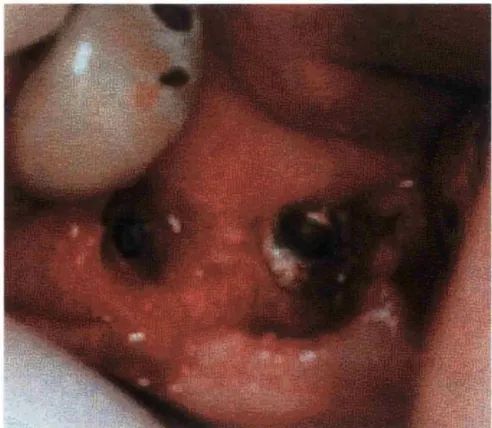 Figure 1.1 Two osseointegrated TI implants as seen during the second stage 