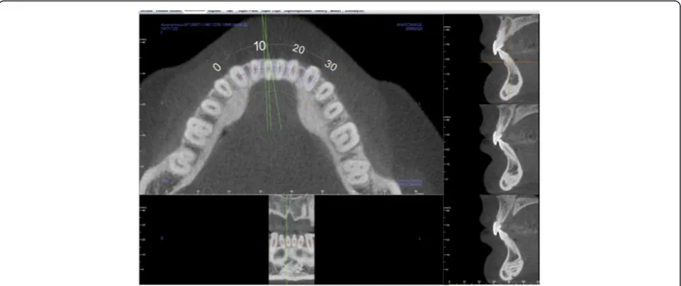 Fig. 1 Horizontal view through the mandibular dentition indicating the location of the sagittal slices to evaluate the alveolar bone and teeth