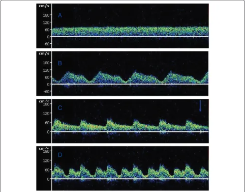 Figure 2 Typical middle cerebral artery flow waveform obtained by transcranial Doppler ultrasonography during extracorporealECMO was combined with IABP support in severe cardiac functional failure.(D)membrane oxygenation