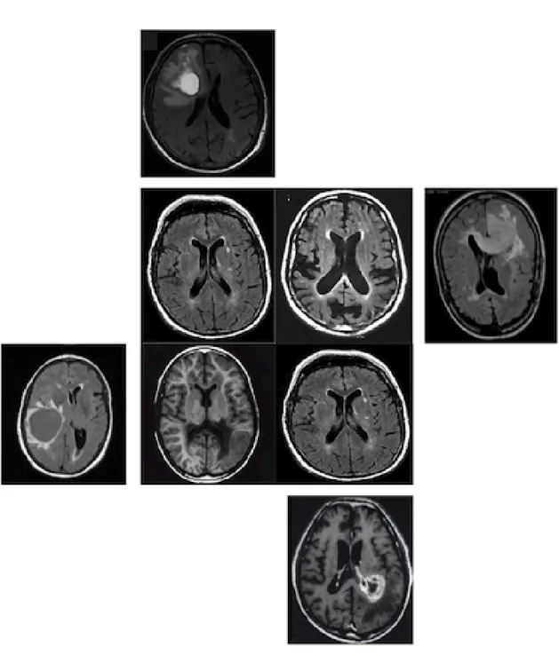 Figure 2.7: The middle 4 figures are normal brain tissue MRIs and the “butterfly” shaped area in each of them is symmetric; the other 4 panels show that when tumors develop and  com-press the normal brain tissue from different directions, the “butterfly-sh