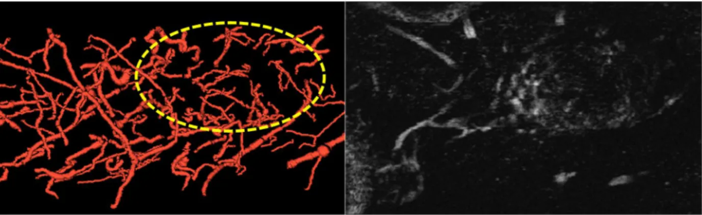 Figure 4. 3. An example of vessels segmented from an AA image. The yellow circle represents  the location of the tumor, which is visible in the right AA image