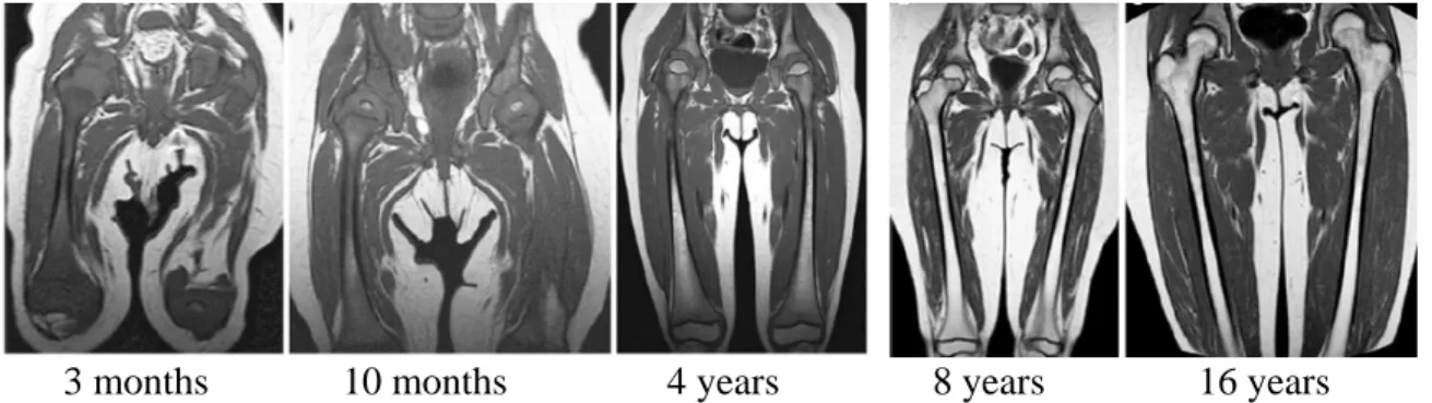 Figure 4: Normal conversion of red bone marrow to yellow bone marrow through childhood  and adolescence