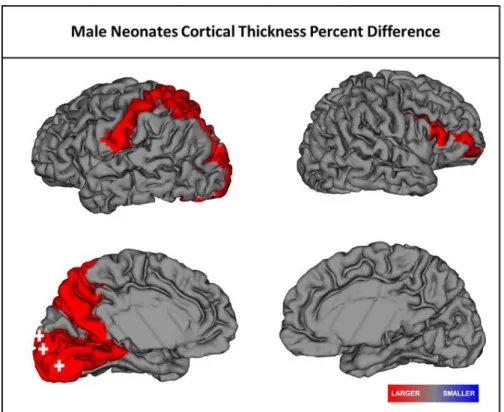 Figure 2.1 Significant regional differences in cortical thickness in male SCZHR neonates when compared to Controls