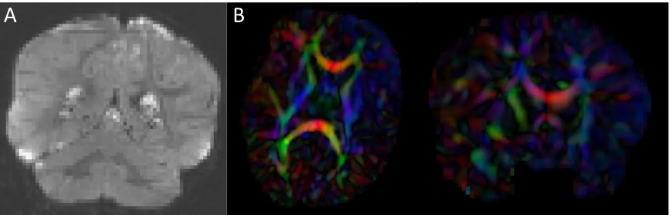 Figure 2.3: Artifacts encountered during quality control. A.) DWI artifact missed by automatic quality control run of DTIPrep, but caught in the visual quality control