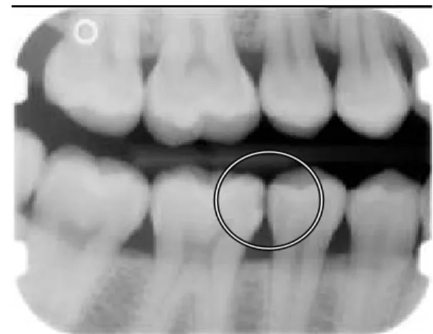 Figure 4. Image Editing to Increase Caries Risk 