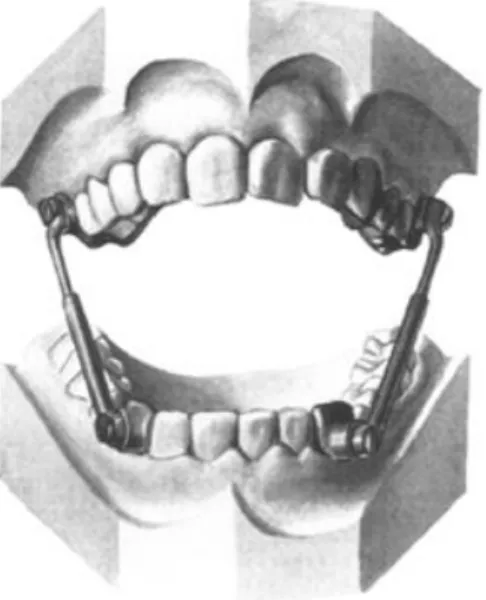Figure A: Original Herbst Design 