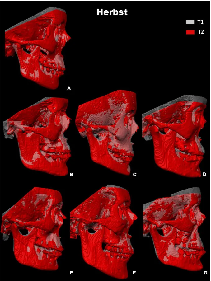Figure 2. Herbst subject T1 semitransparency of T1 and T2 superimposed 3D  renderings registered at the anterior cranial base