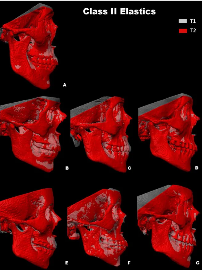 Figure 3. Class II elastic control subject T1 semitransparency of T1 and T2  superimposed 3D renderings registered at the anterior cranial base