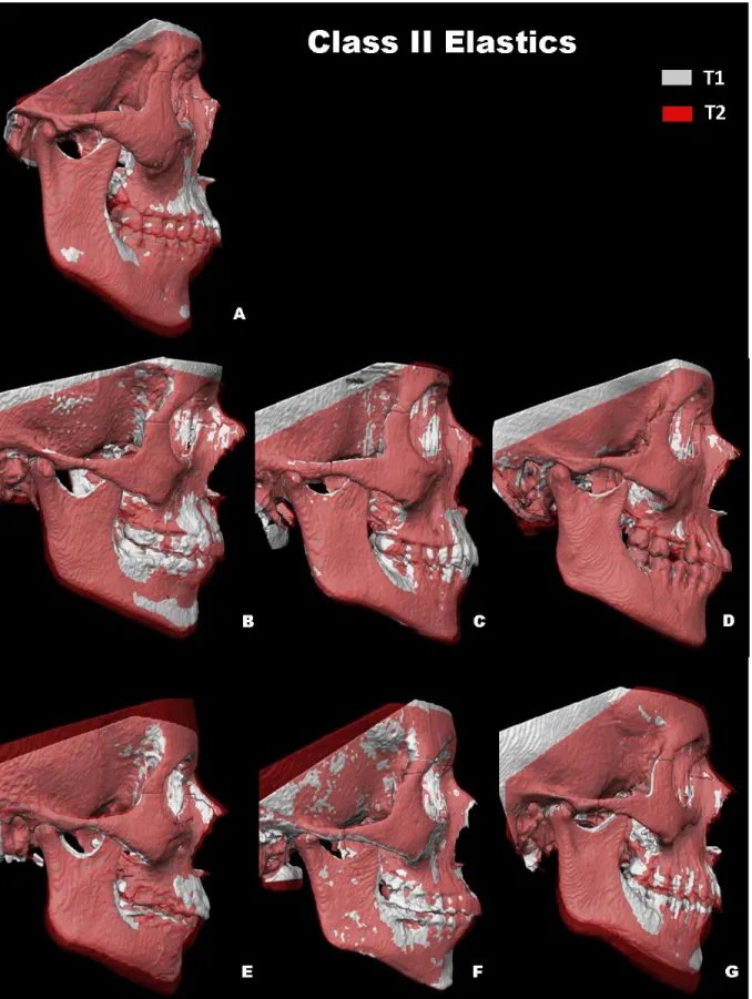 Figure 6. Herbst subject T2 semitransparency of T1 and T2 superimposed 3D  renderings registered at the anterior cranial base