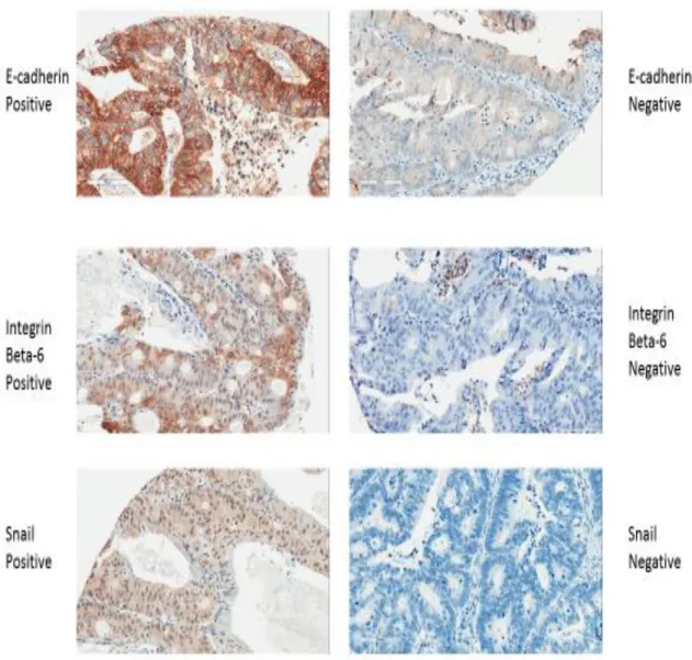 Figure 4. Immunohistochemistry examples for positive and negative staining for each of E- E-cadherin, Integrin beta-6, and Snail 