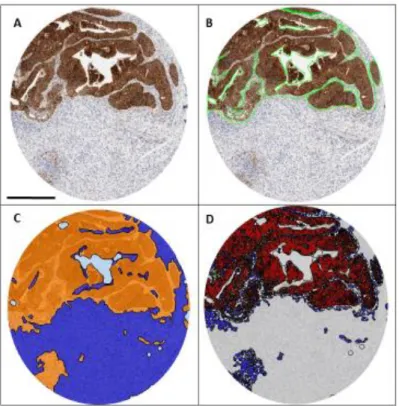 Figure 5. Illustration of Tissue Studio analysis of colon tumor tissue 