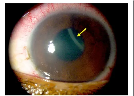 Figure 2 Human ocular dirofilariosis in Brazil. Corneal oedemaand episcleral hyperaemia in the left eye of a 16-year-old boy fromBrazil and a free-swimming filarioid (arrow) in the anterior chamber(adapted from Ref