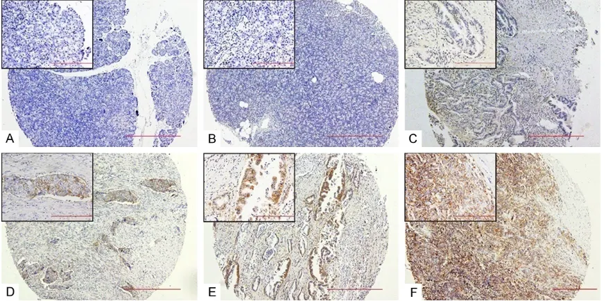 Figure 1. Expression of CD147 detected by immunohistochemistry in pancreatic ductal adenocarcinoma or paired non-neoplastic tissue
