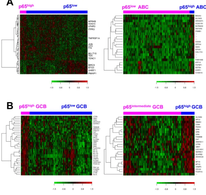 Figure 4. Gene expression analysis for p65 hyperactivation in diffuse large B‐cell lymphoma (DLBCL). ( A) Heatmaps for gene differentially expressed between p65 high  (IHC ≥50%) and p65 low  (IHC <50%) patients in DLBCL overall and in ABC‐DLBCL (false d