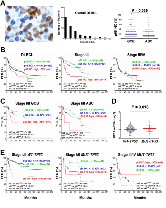 Figure  1.  Nuclear  expression  of  p65  and  its  effect  on  progression‐free  survival  (PFS)  in  diffuse  large  B‐cell  lymphoma (DLBCL)  (A)  Representative  immunohistochemical  analysis  (IHC)  and  histograms  for  p65  nuclear  expression  in  