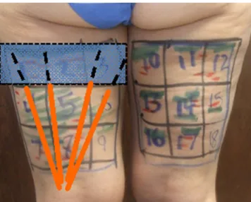 Figure 1. The total treatment dosage in joules is based upon the size of the area, the evaluation of the skin, and the grade of cellulite